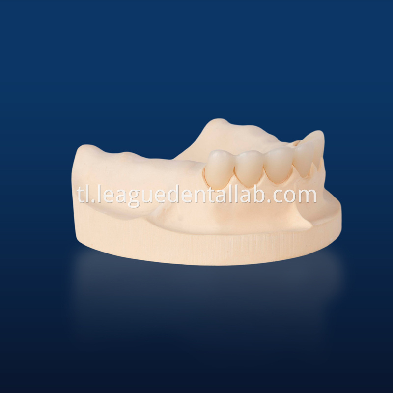 PFZ,Porcelain Fused to Zirconia,Zirconia Layered, Zirconia Veneered